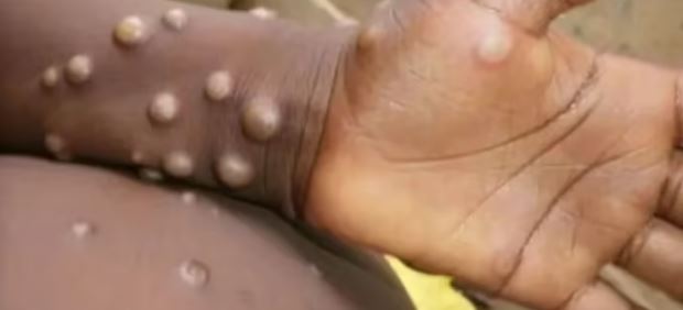 एम पॉक्स