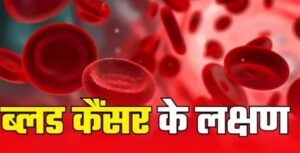 ब्लड कैंसर