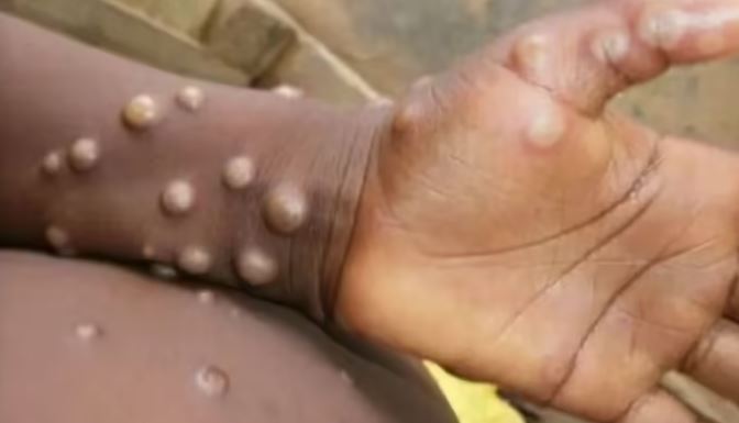 मंकी फॉक्स